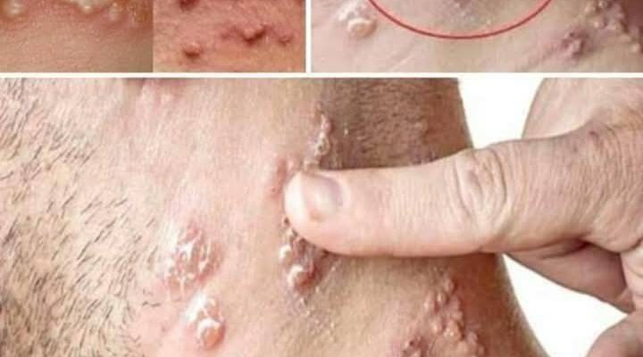 BE CAREFUL, If you spot these dots on your skin, it means you have Ca…see more