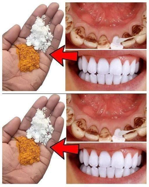 Teeth whitening in just 2 minutes – turning yellow and accumulated tartar into milk-like white and shiny. Full recipe in the first comment-D1-800